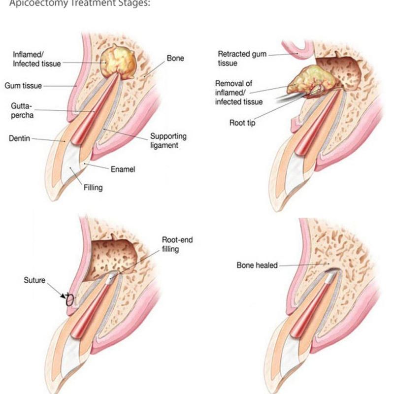 Endodontic-Surgery-Apicoectomy