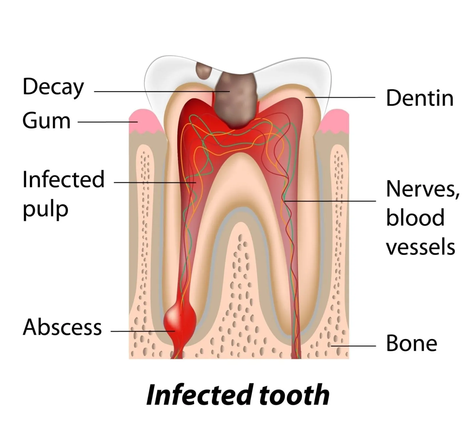 Infected tooth illustration