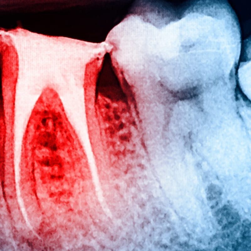 Imaging of tooth requiring root canal