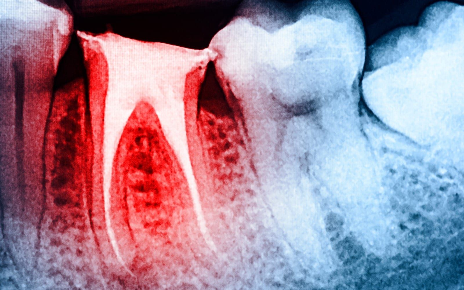 how-much-does-a-root-canal-cost-irvine-root-canal-specialist